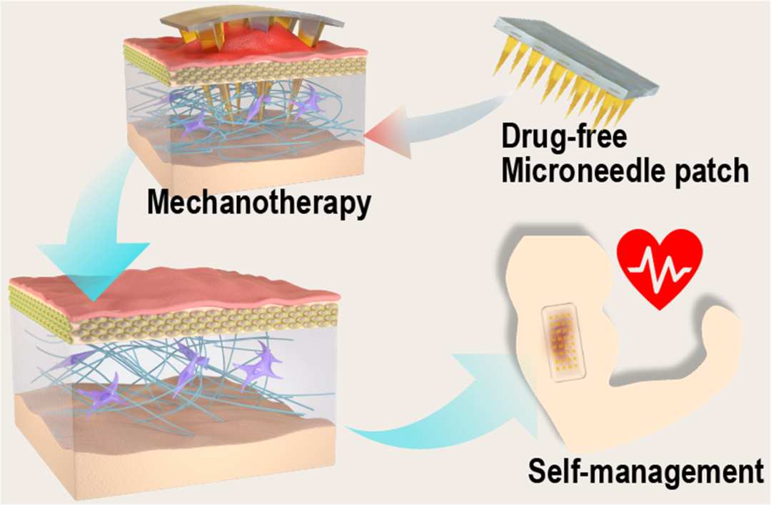 3D打印高精度微针模具助力微针物理治疗增生性瘢痕的构效关系研究